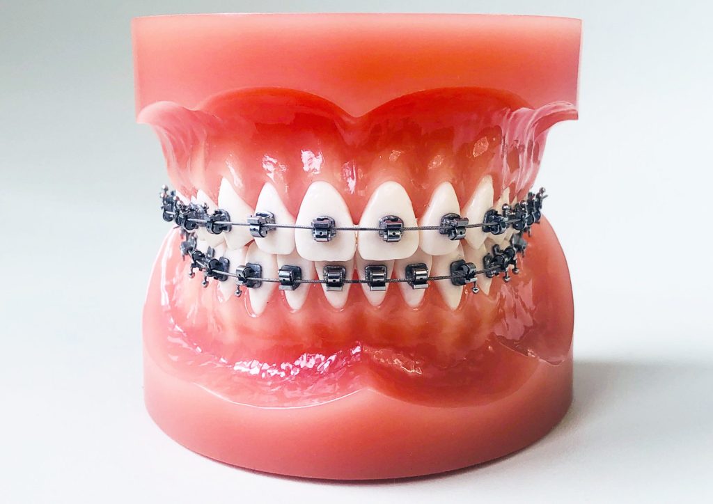 aparat dentar fix cu bracheti