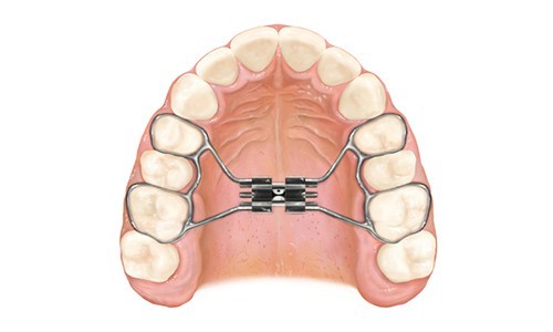 disjunctor, aparat dentar fix